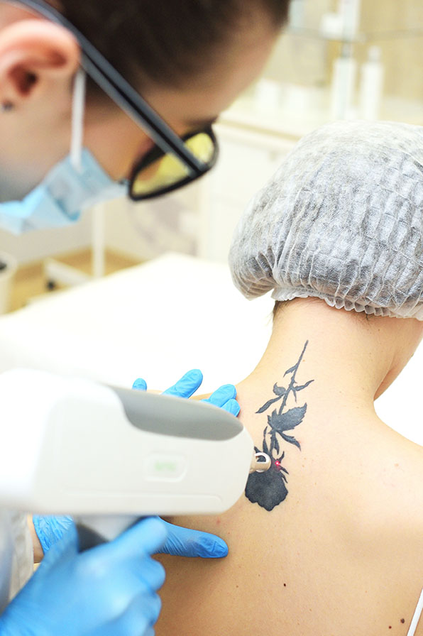 Trattamento medico - Laser rimozione tatuaggi